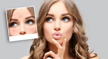 Tipps für Rosacea-Betroffene